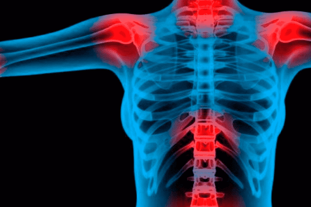 Entendendo o que é fibromialgia: Um guia prático para melhorar sua saúde