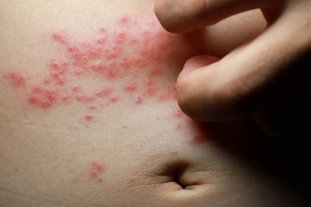 Entenda o que é alergia e os principais tipos