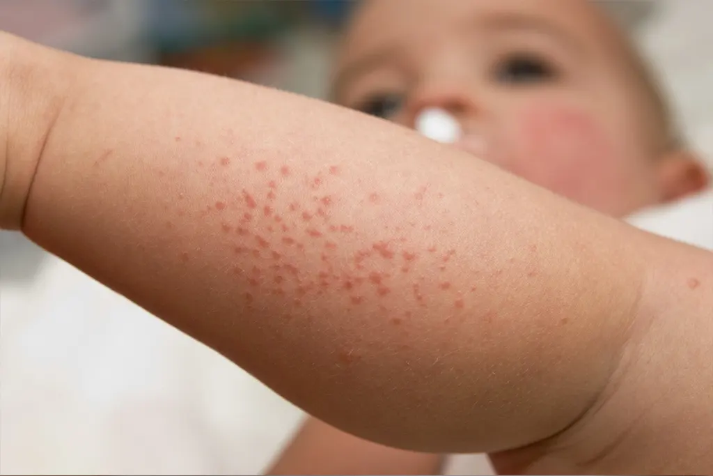 Tipos mais comuns de alergia em criança
