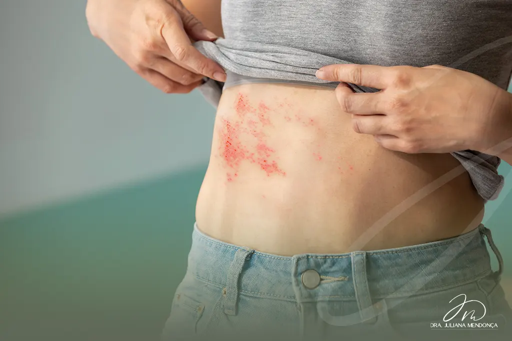 Dor e manchas pelo corpo: entendendo os sintomas de Herpes Zóster